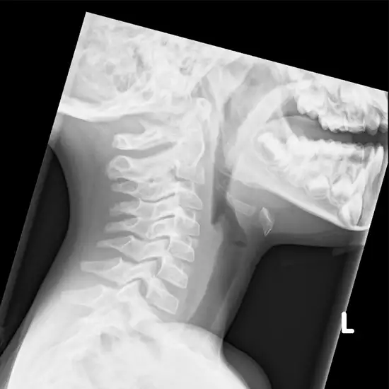 X-ray Soft Tissue Neck LAT View